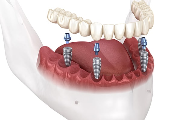 Implant Supported Dentures illustration