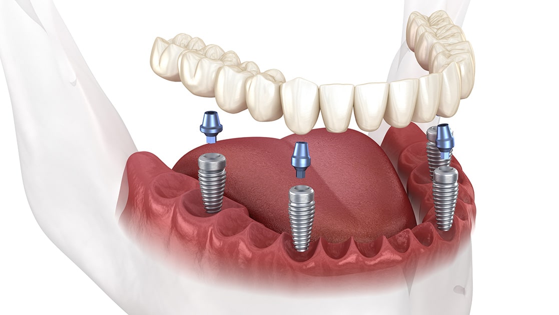 Implant Supported Bridge